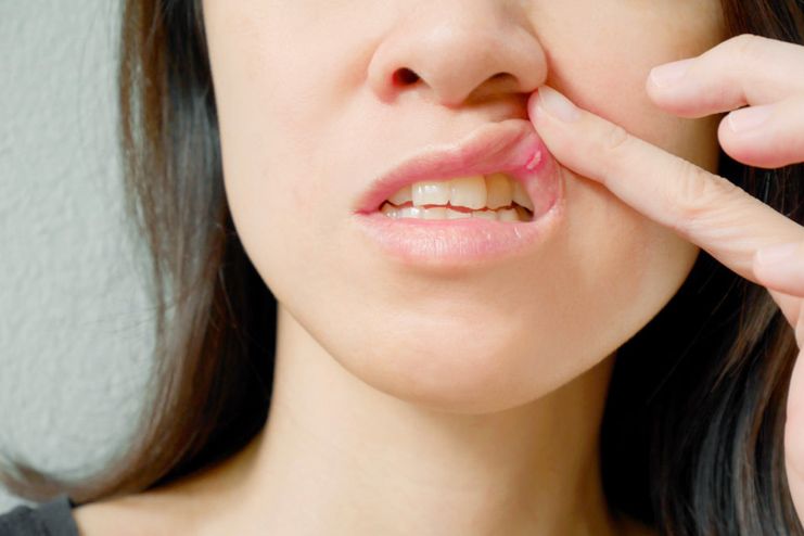 How to prevent getting mouth ulcers