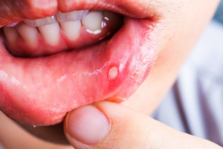 Symptoms of Mouth Ulcers