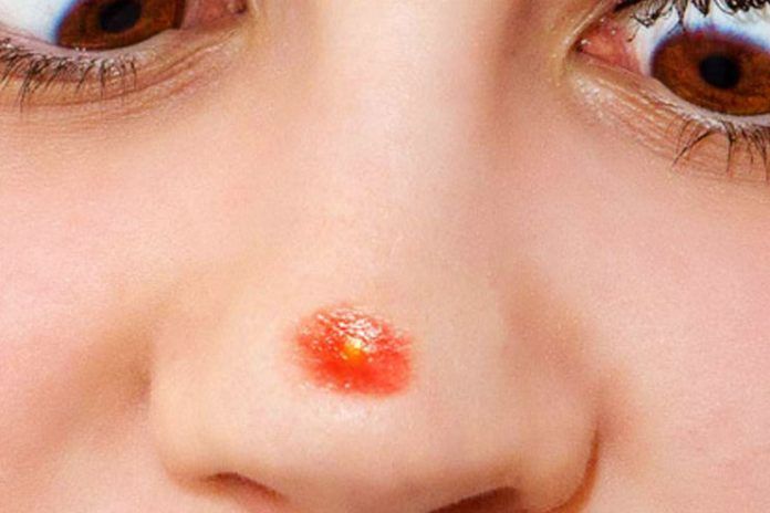 How to Get Rid of Pimple on Nose