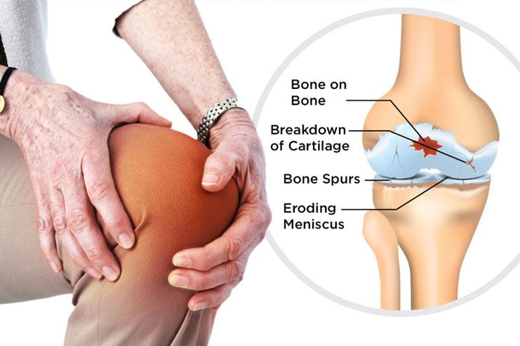 What causes Osteoarthritis