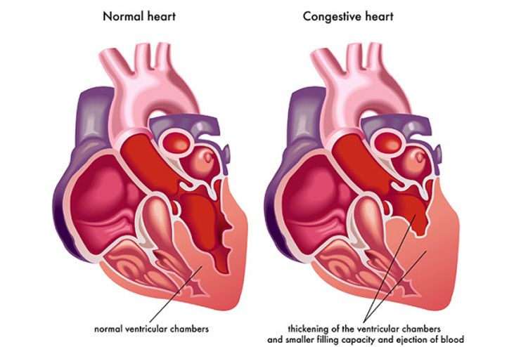 What-is-Congestive-Heart-Failure