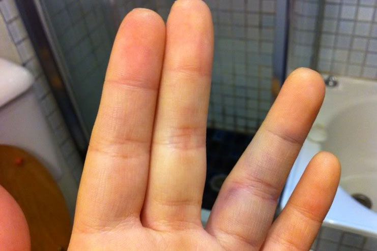 Symptoms of a Jammed Finger