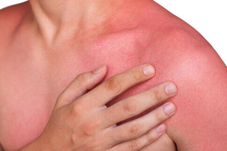 How To Diagnose Sun Poisoning