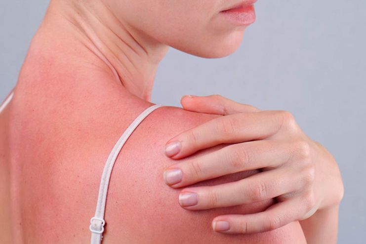 What Are The Signs And Symptoms Of Sun Poisoning