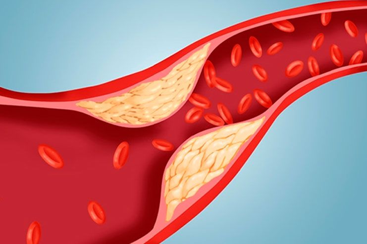 Reduce Blood Triglycerides and Cholesterol levels