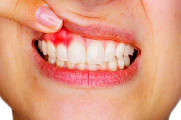 Home remedies for periodontitis