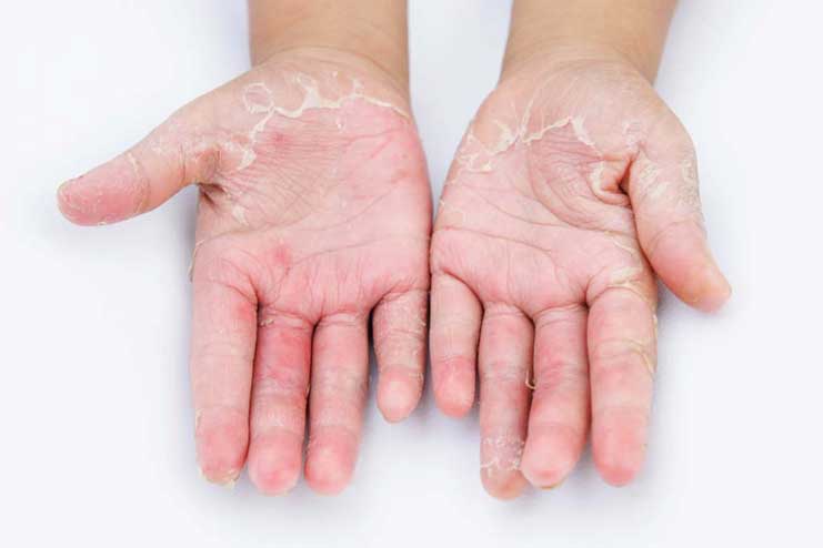 What is a Fungal Skin infection
