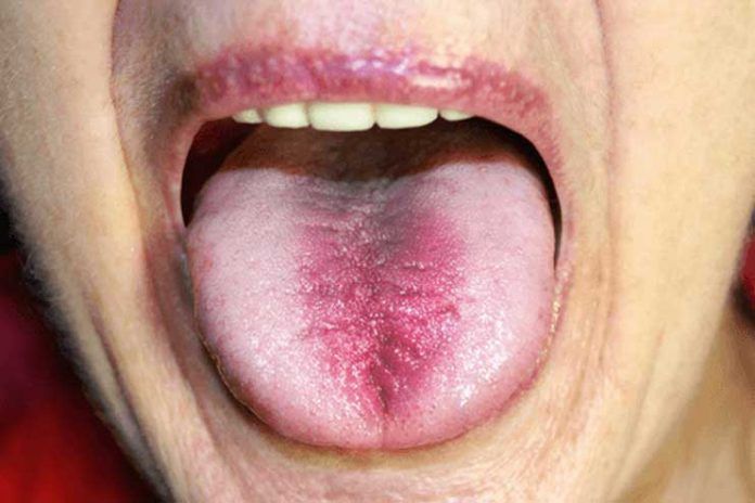 home remedies to treat tongue burn