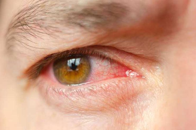 Risks of eye infections