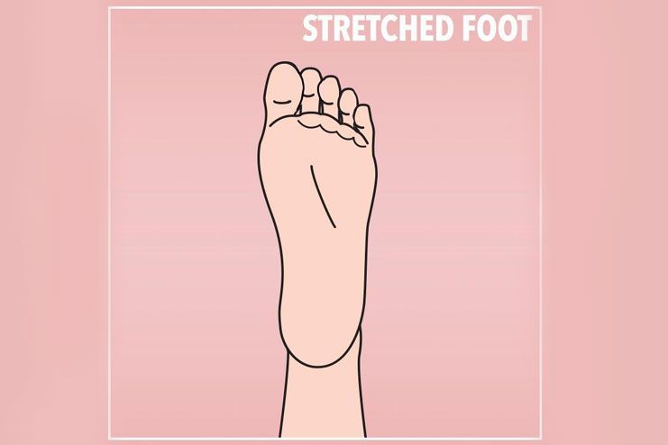 When you have a stretched foot
