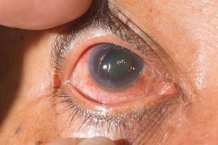 Worsened condition of glaucoma