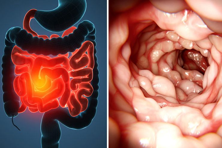 What is Crohns Disease